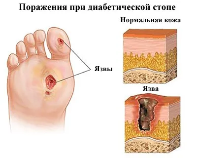 Centrul de medicina complementara - piciorului diabetic