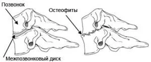 DDDS камшичен симптоми, лечение