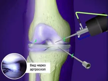 Debridment стави - какво е това, immuninfo