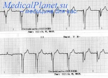 EKG betegeknél pacemaker