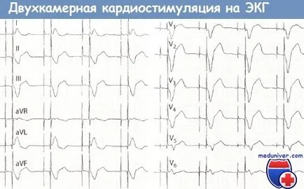 EKG kettős kamra pacemaker (ddd)
