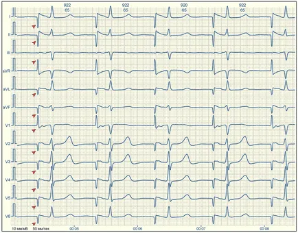 E-cardio 9. leckében (pacemaker)