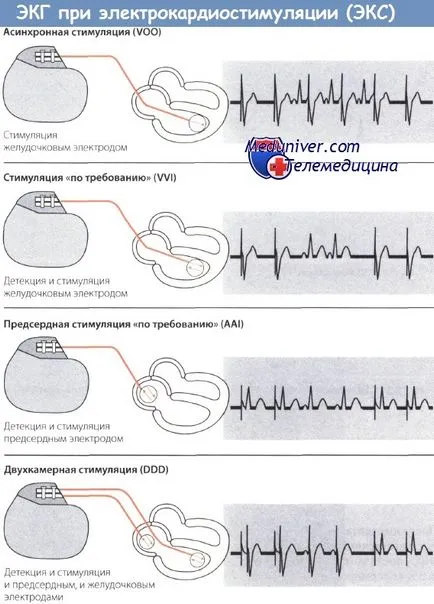 EKG kettős kamra pacemaker (ddd)