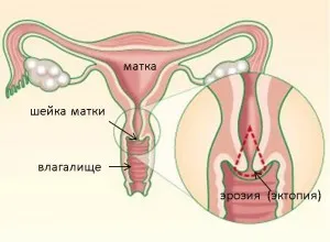 A méhnyak erózió kezelése népi jogorvoslat, a legjobb módja annak, hogy