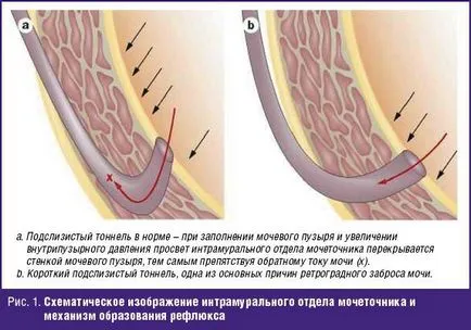 Endoszkópos korrekciója vesicoureteralis reflux gyermekek, # 01