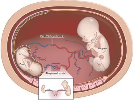 sindrom de transfuzie Twin-la-twin cu gemeni