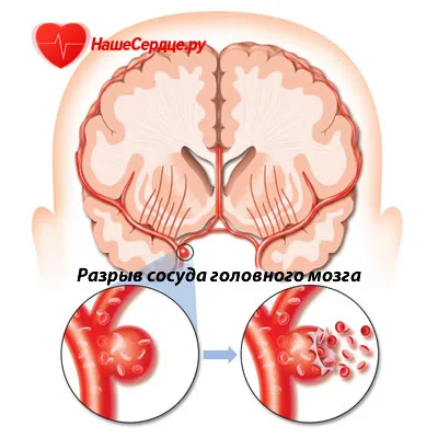 Хеморагичен инсулт лечение, симптоми, прогноза