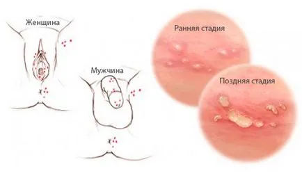 Herpes tip 2 este transmis ca simptomele și tratamentul
