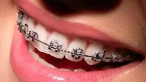 Изкривяването на зъбите, свят без вреда