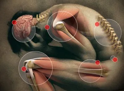 Accident vascular cerebral partea dreapta a efectelor creierului (dreapta) ca live și prognoză
