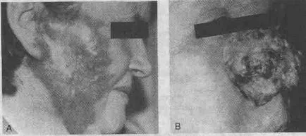 Infecțiile cauzate de micobacterii - Enciclopedii medical