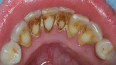 Hogyan kell kezelni a zománc - zománc repedt fogak - Betegségek gyógyítása