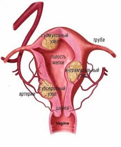 Cum de a trata fibrom uterin mai mare