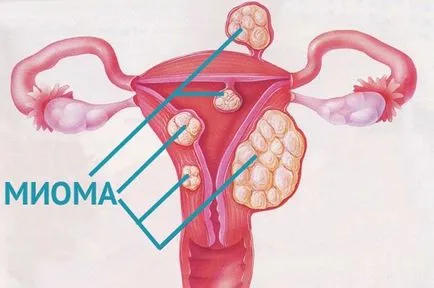 Cum de a trata fibrom uterin mai mare