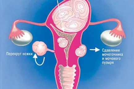 Cum de a trata fibrom uterin mai mare