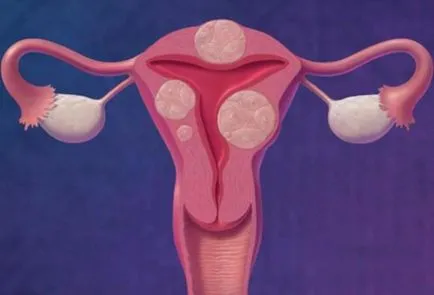 Cum de a trata fibrom uterin mai mare