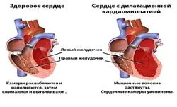 Кардиомиопатия при деца