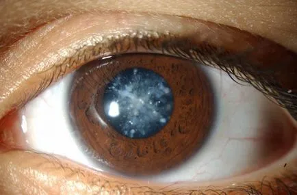 Cataract típusok okok, diagnózis, kezelés és a prognózis