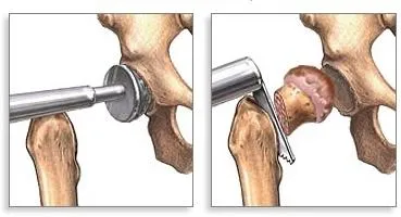 Când aveți nevoie de o înlocuire șold articulațiilor, și ce consecințe ar putea fi în această operațiune