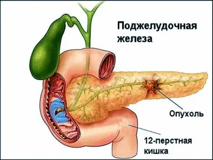 Simptome chistul pancreatice si tratament, cauzele