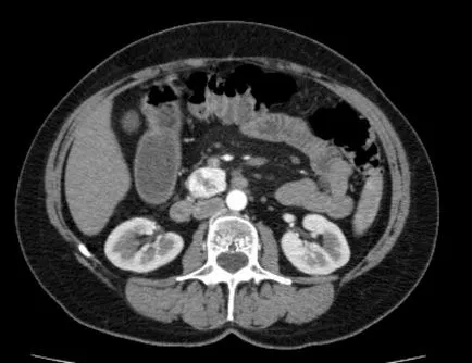 Simptome chistul pancreatice si tratament, cauzele