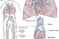hipertrofia concentrică a ventriculului stâng al inimii
