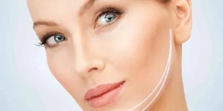 Contour пластмаса, surgiderm, Juvederm, Restylane