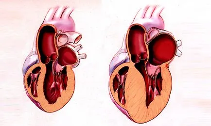 hipertrofia concentrică a ventriculului stâng al inimii