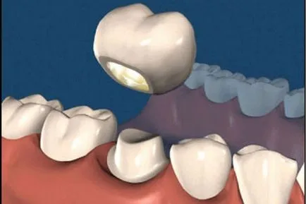 Короната на гаранцията на зъб живот, който дава на лекаря на короната