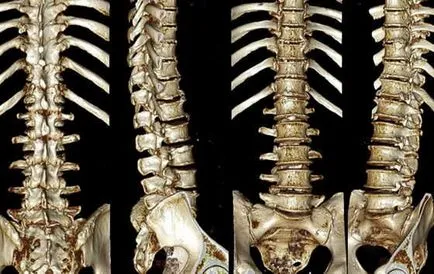 CT a coloanei vertebrale - care arata intrarea in studiu