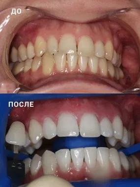 Избелване на светлина ефективност и вреди