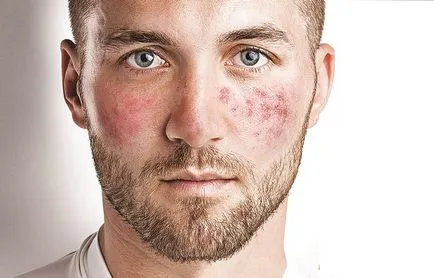 Rosacea az arc és hogyan lehet megelőzni lehet megszabadulni