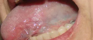 Leukoplakia на устата и езика космати, верукозно и други видове - лечение, симптоми