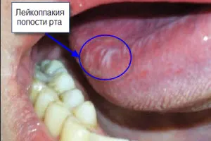 Leukoplakia на устата и езика космати, верукозно и други видове - лечение, симптоми