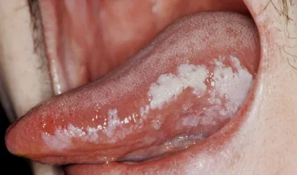 leucoplazie orală - verucos, o, leucoplazia mucoasa moale plat - Simptome și
