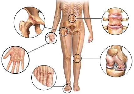 Reumatoid artritisz tünetei, diagnózisa