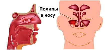 Лечението на полипи в носа без операция как да се премахне