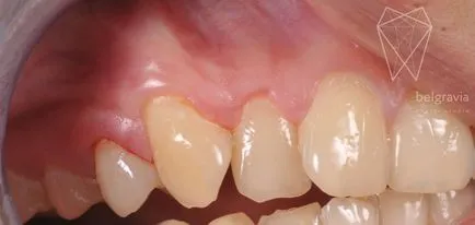 Tratamentul gingiilor (parodontologie)