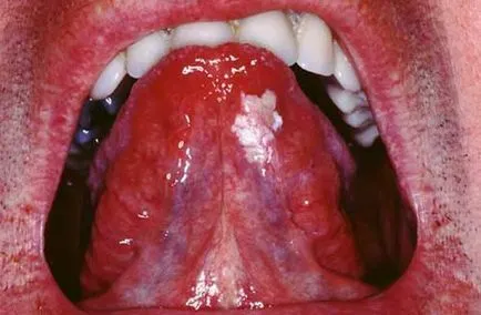 Leukoplakia на устата и езика космати, верукозно и други видове - лечение, симптоми