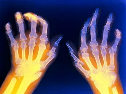 Reumatoid artritisz tünetei, diagnózisa