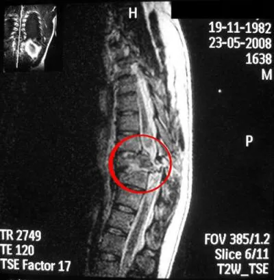 Mágneses rezonancia képalkotás (MRI) a nyaki gerinc
