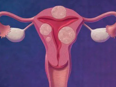 Fibromul uterin mai mari care răspund la întrebare