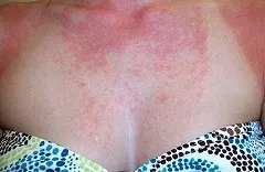 Алергия към слънцето причини и отстраняване