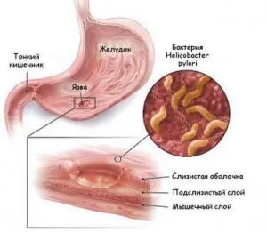 Agravarea simptome ulcer gastric, tratament, dieta