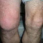 Osteochondrosis, prosztatagyulladás van-e kapcsolat