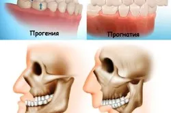 osteotomiával alsó állkapocs