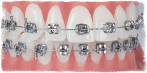 Az alapvető szabályok a fogszabályozó viselése, mind a fogak