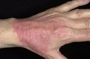 A fő okai és kezelése dermatitis a kézen