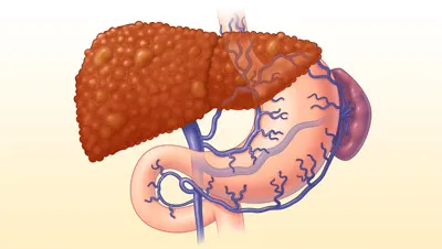 Complicațiile de ciroză hepatică - decât este periculos și consecințele