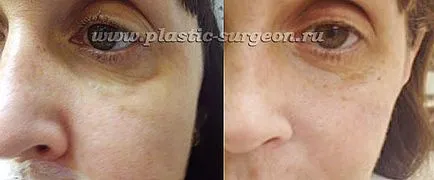 Complicații după materialele plastice contur facial